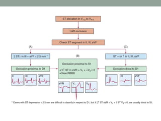 ECG in Acute Myocardial Infarction | PPTX