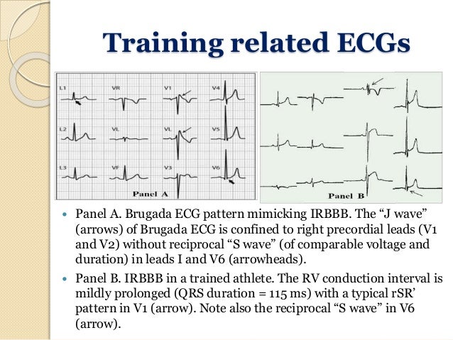 Ecg In Athletes And Young Age Custom Ecg Pattern Ecg In Athletes And Young Age Custom Ecg Pattern