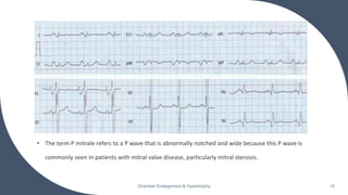 • The term P mitrale refers to a P wave that is abnormally notched and wide because this P wave is
commonly seen in patients with mitral valve disease, particularly mitral stenosis.
Chamber Enlargement & Hypertrophy 15
 