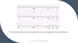 • The mere presence of a twin-peaked P wave is not diagnostic of LA abnormality
Chamber Enlargement & Hypertrophy 16
 