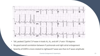 • Tall, peaked ("gothic") P wave in leads IIL, IIL, and aVF ,P axis> 70 degrees
• No good overall correlation between P pulmonale and right atrial enlargement
• Severity of COPD is more related to rightward P wave axis than to P wave amplitude
Chamber Enlargement & Hypertrophy 21
 
