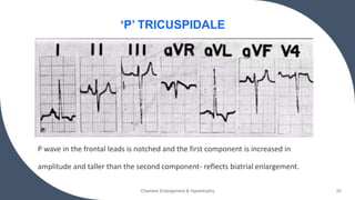 P wave in the frontal leads is notched and the first component is increased in
amplitude and taller than the second component- reflects biatrial enlargement.
Chamber Enlargement & Hypertrophy 22
‘P’ TRICUSPIDALE
 