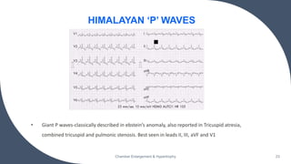 • Giant P waves-classically described in ebstein’s anomaly, also reported in Tricuspid atresia,
combined tricuspid and pulmonic stenosis. Best seen in leads II, III, aVF and V1
Chamber Enlargement & Hypertrophy 23
HIMALAYAN ‘P’ WAVES
 