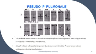• Tall peaked P waves in inferior leads in absence of right atrial enlargement. Seen in hypertensive
heart disease with/without heart failure .
• Actually reflects Left atrial enlargement due to increase in the later P-wave forces without
prolongation of atrial depolarisation.
Chamber Enlargement & Hypertrophy 24
PSEUDO ‘P’ PULMONALE
 