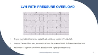 • T wave inverted in left oriented leads V5, V6, I, AVL and upright in V1, V2, AVR.
• Inverted T wave - blunt apex, asymmetrical limb, the proximal limb is shallower than distal limb.
• Associated ST segment is minimally depressed with slight upward convexity
Chamber Enlargement & Hypertrophy 32
LVH WITH PRESSURE OVERLOAD
 