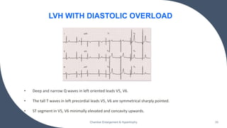 • Deep and narrow Q waves in left oriented leads V5, V6.
• The tall T waves in left precordial leads V5, V6 are symmetrical sharply pointed.
• ST segment in V5, V6 minimally elevated and concavity upwards.
Chamber Enlargement & Hypertrophy 33
LVH WITH DIASTOLIC OVERLOAD
 