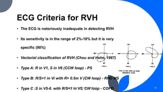 ECG Criteria for RVH
• The ECG is notoriously inadequate in detecting RVH
• Its sensitivity is in the range of 2%-18% but it is very
specific (90%)
• Vectorial classification of RVH (Chou and Helm, 1967)
• Type A: R in V1, S in V6 (CCW loop) - PS
• Type B: R/S>1 in Vi with R> 0.5m V (CW loop) - RHD MS
• Type C :S in V5-6. with R/S<1 in V5, CW loop - COPD
Chamber Enlargement & Hypertrophy 42
 