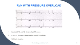 • Leads aVR, V1, and V2- abnormally tall R waves.
• I, aVL, V5, V6- Deep S waves leading to RS or rS complex
• Right axis deviation
Chamber Enlargement & Hypertrophy 43
RVH WITH PRESSURE OVERLOAD
 