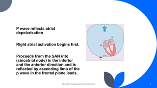 Chamber Enlargement & Hypertrophy 8
P wave reflects atrial
depolarisation
Right atrial activation begins first.
Proceeds from the SAN into
(sinoatrial node) in the inferior
and the anterior direction and is
reflected by ascending limb of the
p wave in the frontal plane leads.
 