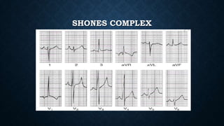 Sones Complex Ecg in congenital heart disease | PPTX