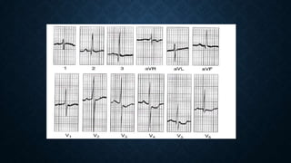 Ecg in congenital heart disease | PPTX
