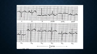 Ecg in congenital heart disease | PPTX