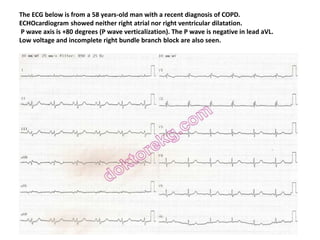 The ECG below is from a 58 years-old man with a recent diagnosis of COPD.
ECHOcardiogram showed neither right atrial nor right ventricular dilatation.
P wave axis is +80 degrees (P wave verticalization). The P wave is negative in lead aVL.
Low voltage and incomplete right bundle branch block are also seen.
 