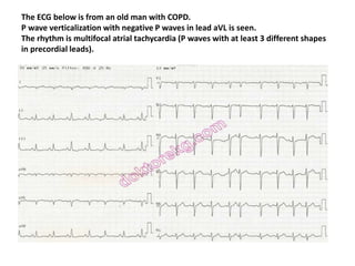 The ECG below is from an old man with COPD.
P wave verticalization with negative P waves in lead aVL is seen.
The rhythm is multifocal atrial tachycardia (P waves with at least 3 different shapes
in precordial leads).
 