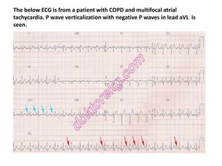 The below ECG is from a patient with COPD and multifocal atrial
tachycardia. P wave verticalization with negative P waves in lead aVL is
seen.
 
