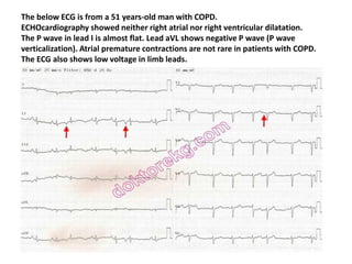 The below ECG is from a 51 years-old man with COPD.
ECHOcardiography showed neither right atrial nor right ventricular dilatation.
The P wave in lead I is almost flat. Lead aVL shows negative P wave (P wave
verticalization). Atrial premature contractions are not rare in patients with COPD.
The ECG also shows low voltage in limb leads.
 