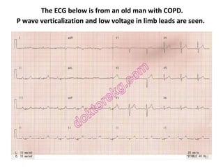 The ECG below is from an old man with COPD.
P wave verticalization and low voltage in limb leads are seen.
 