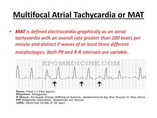 Multifocal Atrial Tachycardia or MAT
• MAT is defined electrocardio-graphically as an atrial
tachycardia with an overall rate greater than 100 beats per
minute and distinct P waves of at least three different
morphologies. Both PR and R-R intervals are variable.
 