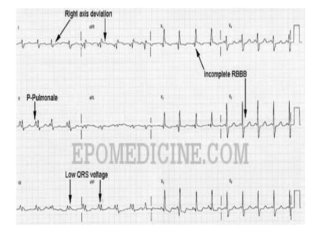 ECG/EKG changes in Chronic Obstructive Pulmonary Diseases