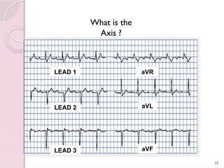 Different ECGs interpretation in Emergency | PPTX