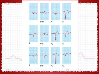 ECG In Ischemic Heart Disease - Dr Vivek Baliga Review | PPT