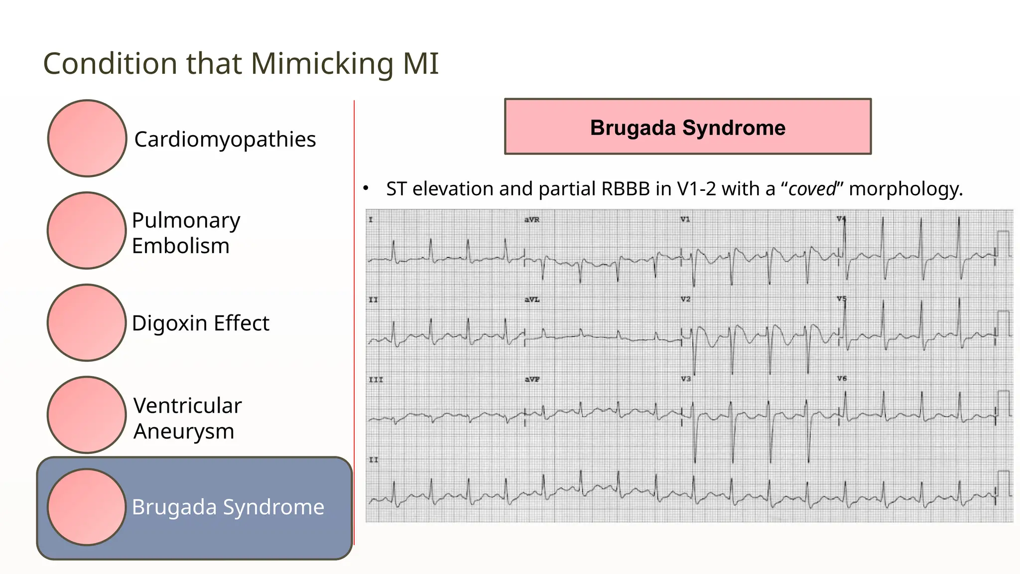 ECG in Ischemia Heart Disease RSMWM.pptx