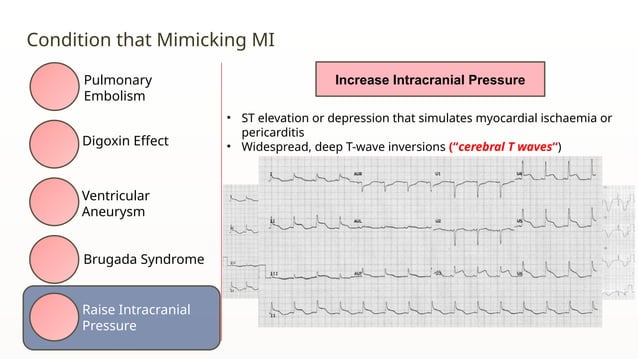 ECG in Ischemia Heart Disease RSMWM.pptx