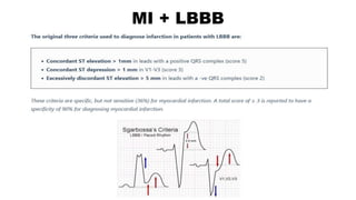 MI + LBBB
 
