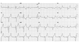 ECG in MI.pptx