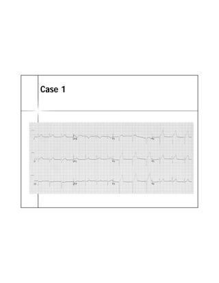 ECG TRONG STEMI | PDF