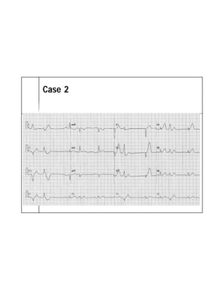 ECG TRONG STEMI | PDF