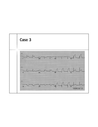 ECG TRONG STEMI | PDF