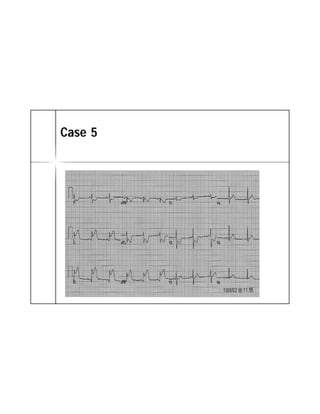 ECG TRONG STEMI | PDF