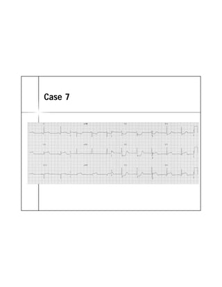 ECG TRONG STEMI | PDF