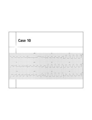 ECG TRONG STEMI | PDF