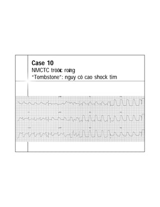ECG TRONG STEMI | PDF