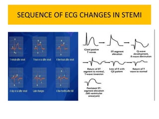 SEQUENCE OF ECG CHANGES IN STEMI
 