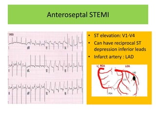 Anteroseptal STEMI
• ST elevation: V1-V4
• Can have reciprocal ST
depression inferior leads
• Infarct artery : LAD
 