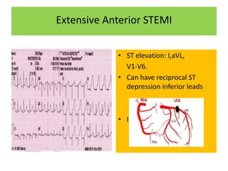 Extensive Anterior STEMI
• ST elevation: I,aVL,
V1-V6.
• Can have reciprocal ST
depression inferior leads
• Infarct artery : LAD
 