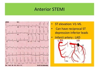 Anterior STEMI
• ST elevation: V1-V6.
• Can have reciprocal ST
depression inferior leads
• Infarct artery : LAD
 