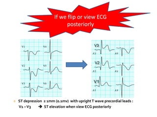 If we flip or view ECG
posteriorly
 ST depression ≥ 1mm (0.1mv) with uprightT wave precordial leads :
V1 –V3  ST elevation when view ECG posteriorly
 