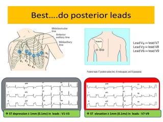  ST depression ≥ 1mm (0.1mv) in leads : V1-V3  ST elevation ≥ 1mm (0.1mv) in leads : V7-V9
 