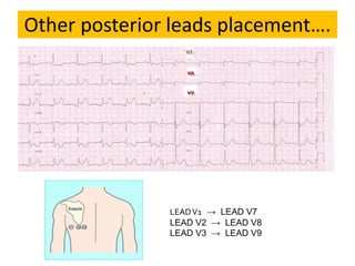 Other posterior leads placement….
LEADV1 → LEAD V7
LEAD V2 → LEAD V8
LEAD V3 → LEAD V9
 