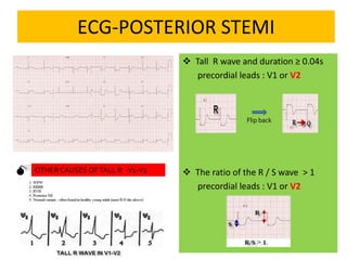 ECG-POSTERIOR STEMI
 Tall R wave and duration ≥ 0.04s
precordial leads : V1 or V2
 The ratio of the R / S wave > 1
precordial leads : V1 or V2
Flip back
 OTHER CAUSES OFTALL R -V1-V2
 