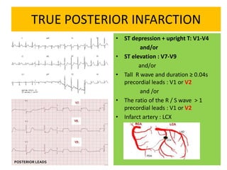 TRUE POSTERIOR INFARCTION
• ST depression + upright T: V1-V4
and/or
• ST elevation : V7-V9
and/or
• Tall R wave and duration ≥ 0.04s
precordial leads : V1 or V2
and /or
• The ratio of the R / S wave > 1
precordial leads : V1 or V2
• Infarct artery : LCX
POSTERIOR LEADS
 