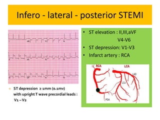 Infero - lateral - posterior STEMI
• ST elevation : II,III,aVF
V4-V6
• ST depression: V1-V3
• Infarct artery : RCA
 ST depression ≥ 1mm (0.1mv)
with uprightT wave precordial leads :
V1 –V2
 