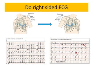 Do right sided ECG
 