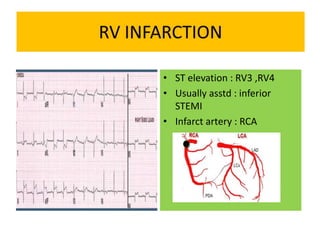 • ST elevation : RV3 ,RV4
• Usually asstd : inferior
STEMI
• Infarct artery : RCA
 
