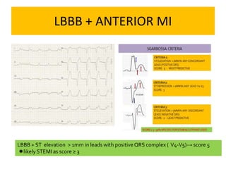 LBBB + ANTERIOR MI
LBBB + ST elevation > 1mm in leads with positive QRS complex ( V4-V5)→ score 5
likely STEMI as score ≥ 3
 
