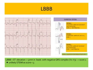 LBBB
LBBB + ST elevation > 5mm in leads with negative QRS complex (V1-V3) → score 2
 unlikely STEMI as score < 3
 